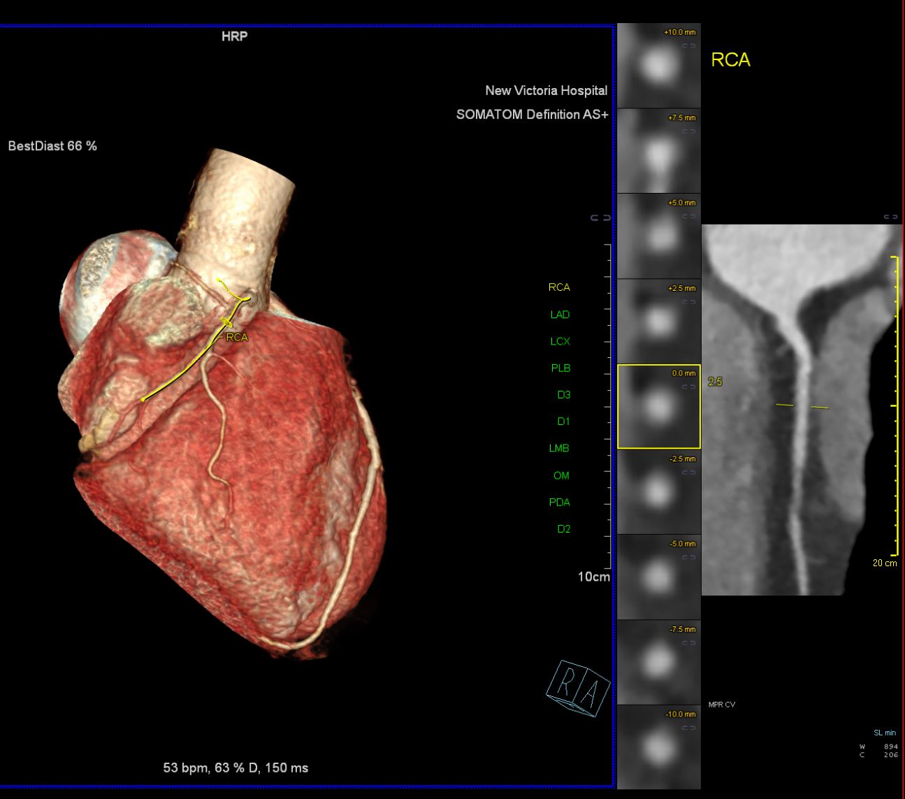 New NonInvasive CT Coronary Angiogram Service New Victoria Hospital